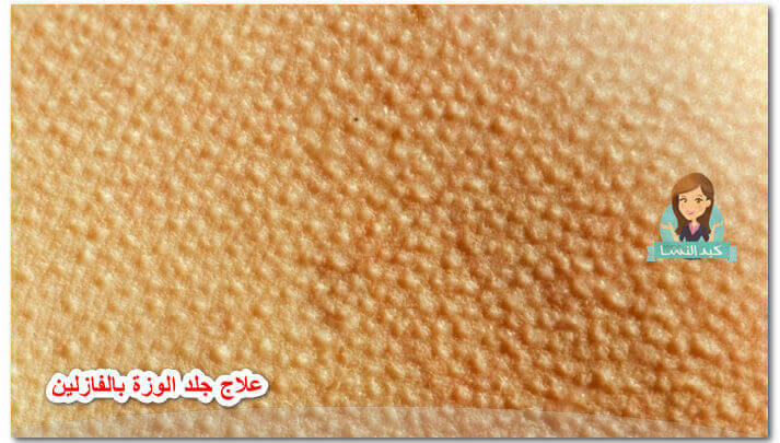 Photo of علاج جلد الوزة بالفازلين