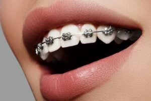 أنواع زراعة الأسنان