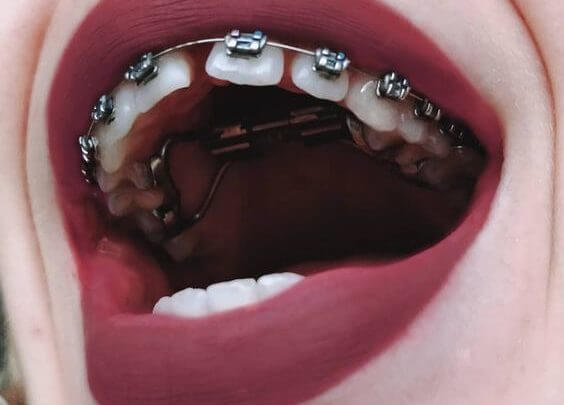 Photo of كل ما تريد معرفته عن تركيب الأسنان الثابتة مميزاتها وعيوبها