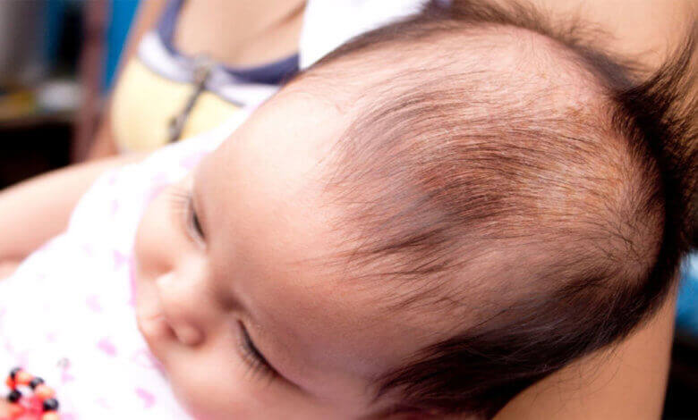 الشعر الخفيف عند الأطفال مشكلة تؤرق جميع الأمهات